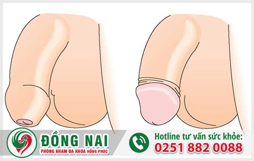 Bao quy đầu bình thường là như thế nào?