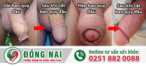 Bao quy đầu phồng rộp – Nam giới không được chủ quan