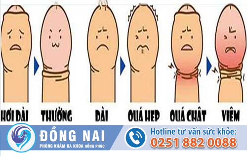 Bệnh bao quy đầu gồm những bệnh gì?