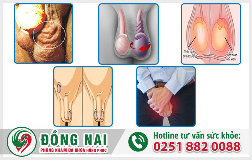 Bị bệnh tinh hoàn khám ở bệnh viện chuyên khoa nào?