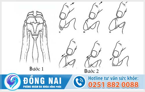 Các bước lột bao quy đầu bằng tay