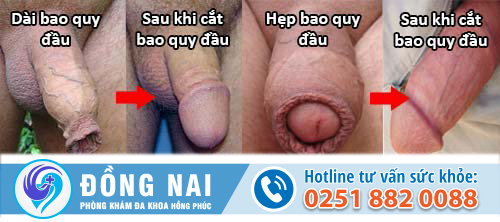 Hình ảnh hẹp bao quy đầu