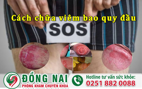 Cách Điều Trị Viêm Bao Quy Đầu