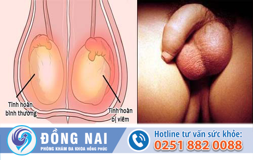 Điều trị viêm tinh hoàn sau quai bị