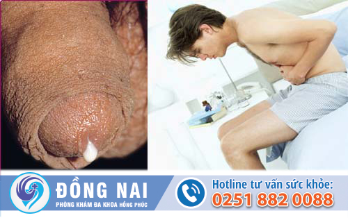Dương vật chảy mủ - nam giới đang mắc bệnh lậu?