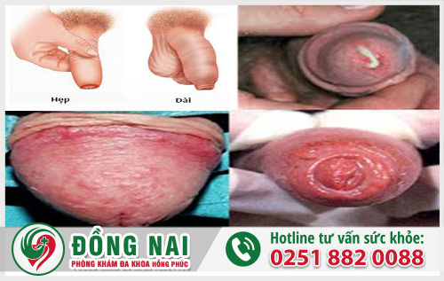  Dương vật nóng rát ở nam giới xuất phát từ nhiều bệnh nguy hiểm