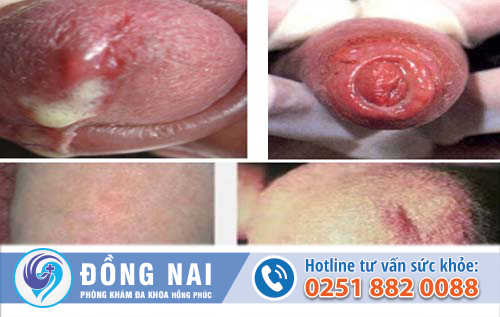 Dấu hiệu bệnh lậu ở cơ quan sinh dục nam