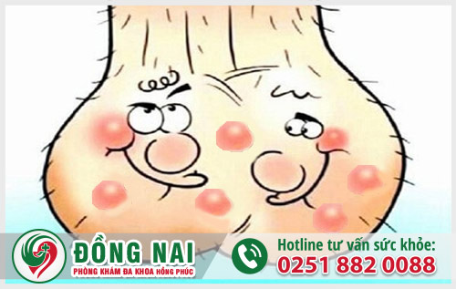 Nổi mụn ở tinh hoàn cảnh báo bệnh gì?