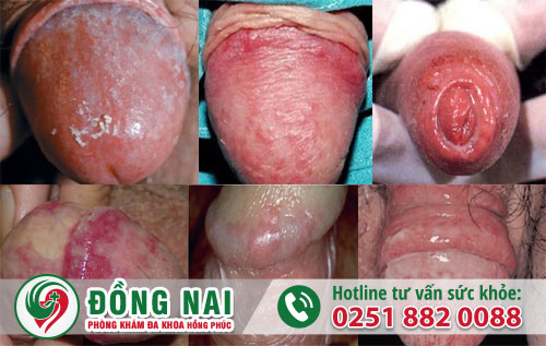 Nguyên nhân gây ra nấm ở bao quy đầu