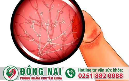 Nam giới cần nhận biết thế nào về viêm bao quy đầu