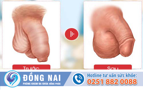 Những ảnh hưởng của dài hẹp bao quy đầu nếu không cắt