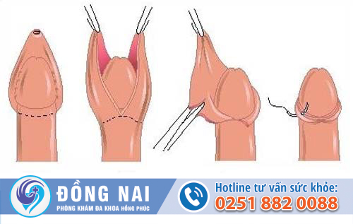 Những phương pháp cắt bao quy đầu