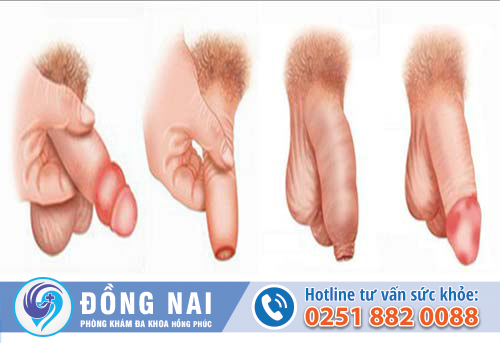 Những trường hợp cần cắt bao quy đầu