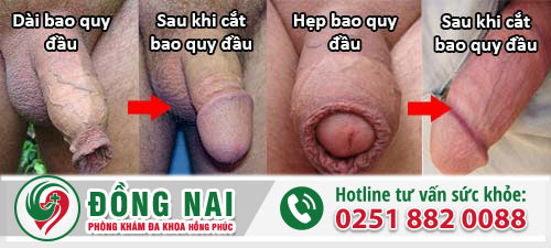 Hình ảnh sau khi cắt bao quy đầu