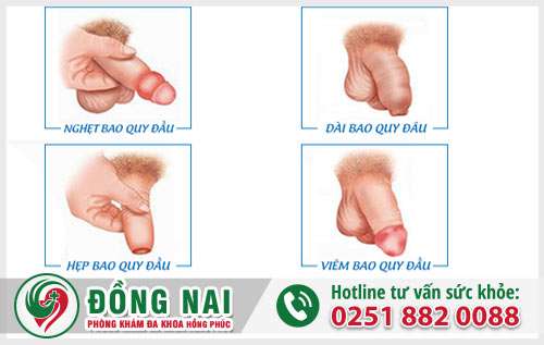 Những trường hợp phải cắt bao quy đầu 