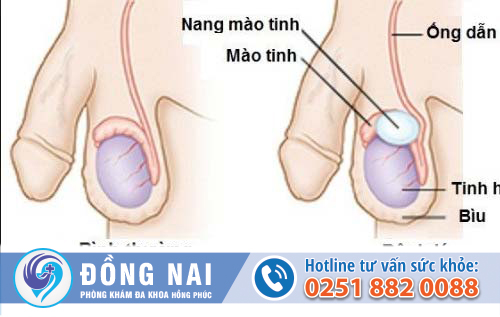 nổi hạch ở tinh hoàn