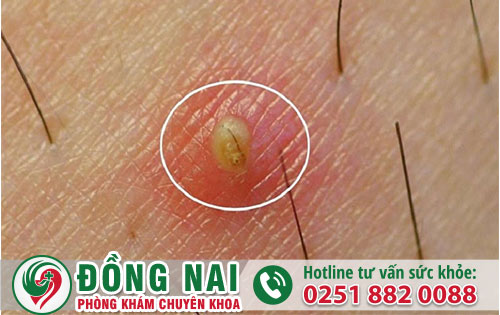Nổi Mụn Ở Vùng Kín Nam Giới