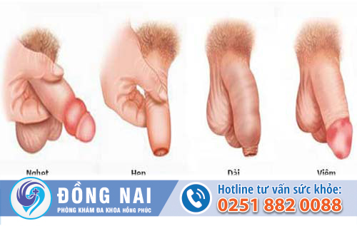 Phương pháp cắt bao quy đầu an toàn không đau