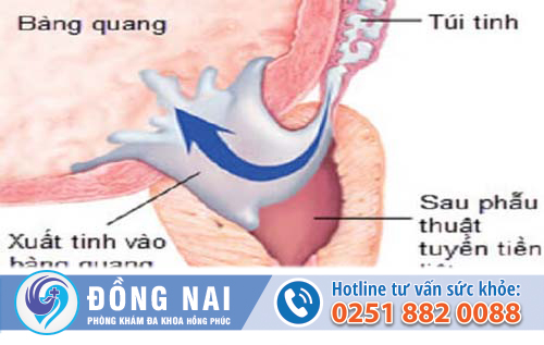 Thế nào là xuất tinh ngược dòng?