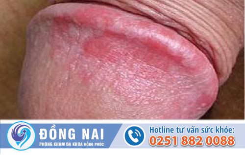 Quy đầu sưng đỏ là bị làm sao?