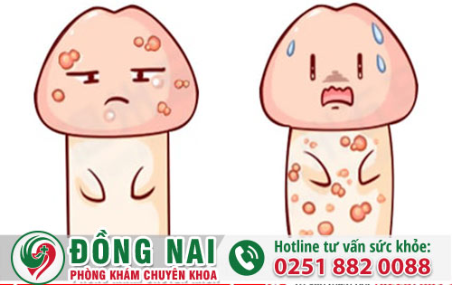 Quý Ông Nổi Mụn Dương Vật Cần Coi Chừng