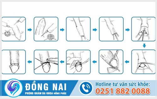 Tiến hành cắt bao quy đầu