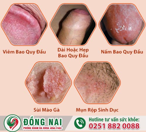 Sưng ngứa bao quy đầu - Nam giới chớ nên xem thường