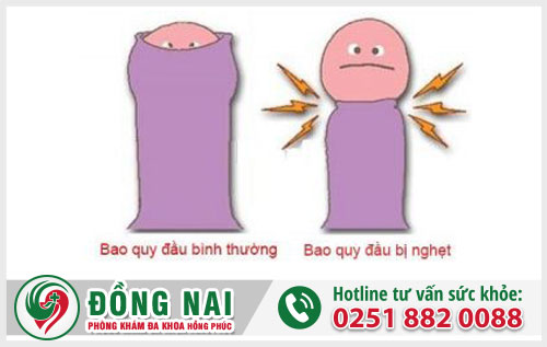 Tác hại bệnh bao quy đầu khiến nam giới hoảng hồn