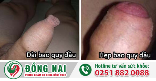 Tác hại bệnh bao quy đầu khiến nam giới hoảng hồn