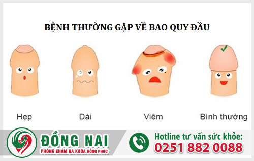 Cắt bao quy đầu là thế nào và địa chỉ thực hiện uy tín