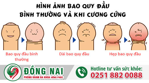 Các trường hợp điển hình cần cắt bao quy đầu