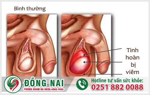 Tinh hoàn to bất thường là vì sao?