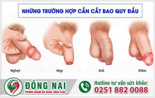 Những trường hợp nào nên cắt bao quy đầu