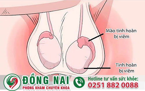 Viêm Mào Tinh Hoàn -Bệnh Nam Khoa Nguy Hiểm Cần Được Điều Trị Ngay