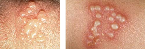 Herpes sinh dục